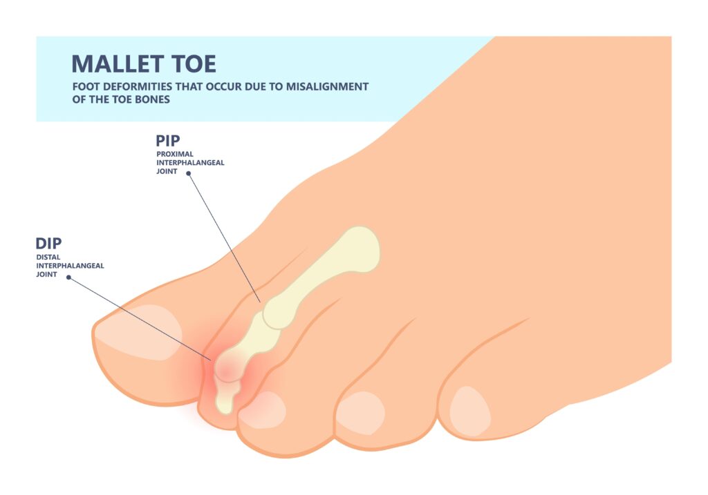 Mallet toe