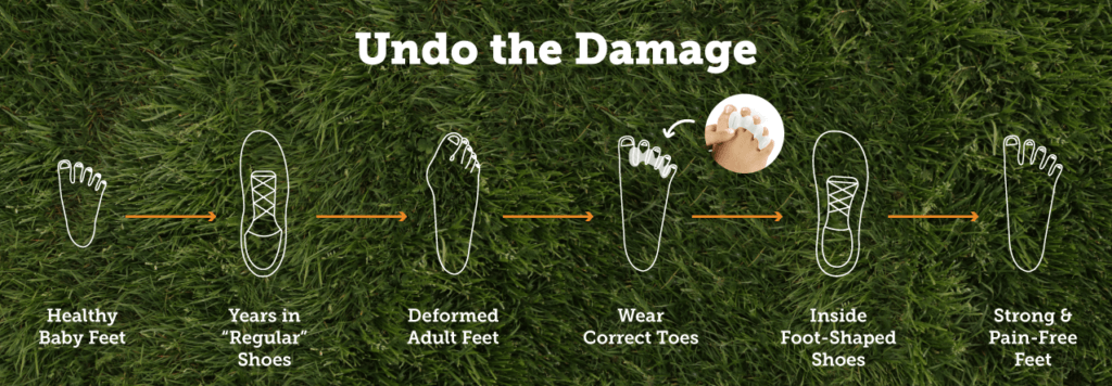 Comparison of healthy foot shapes